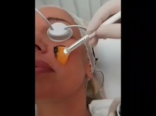 Peeling chimico - Dr.ssa Michela Centrone