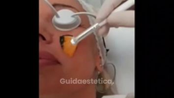 Peeling chimico - Dr.ssa Michela Centrone