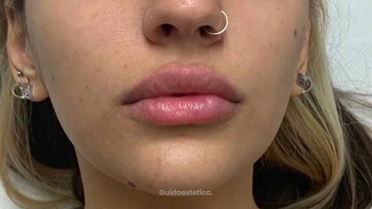 Filler labbra .- Studio medico Monica De Stefani