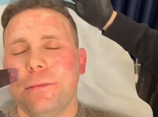 PPM Medical Laser Resurfacing per cicatrici da acne, pori dilatati e macchie della pelle