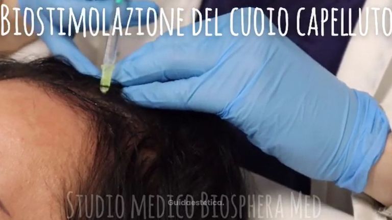 Trapianto capelli - Studio medico BiospheraMed