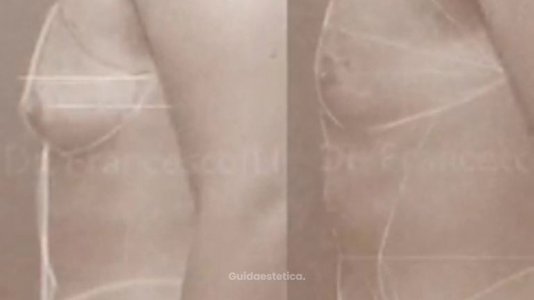 Risultato Vaser Lipo