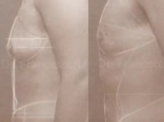 Risultato Vaser Lipo