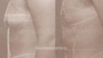 Risultato Vaser Lipo