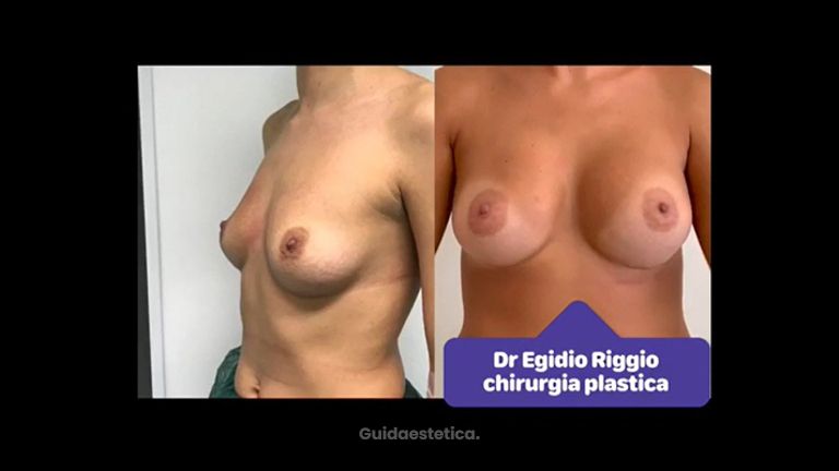 Mastoplastica additiva - Dott. Egidio Riggio