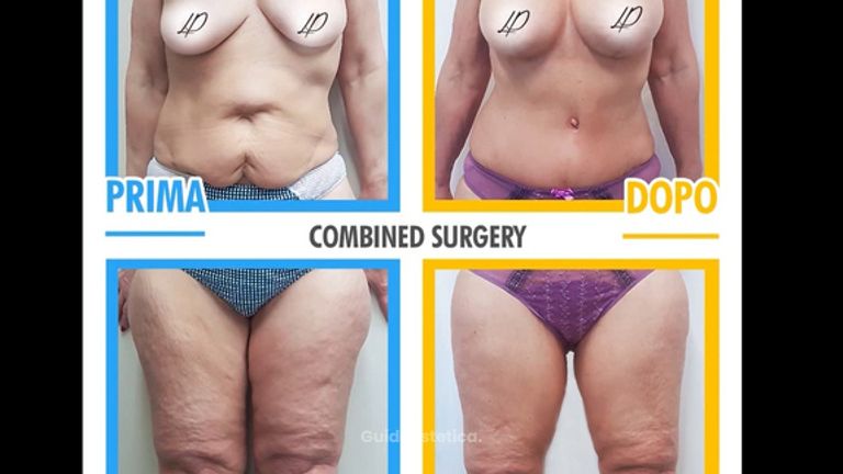 Combined surgery