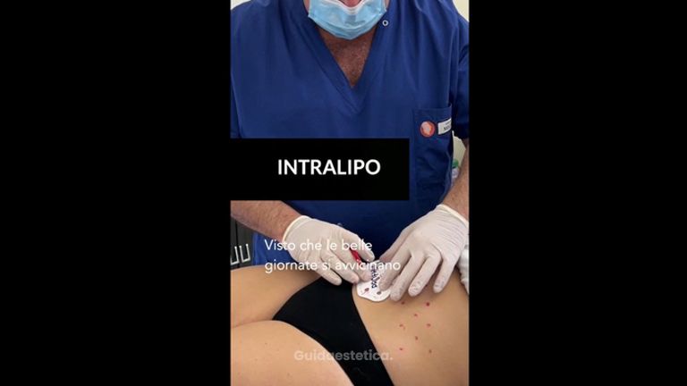 Intralipo - Dott.Maurizio Cursano