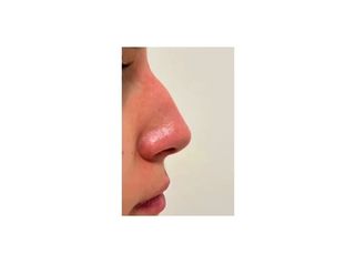 Dott. Giovanni Migliorini Rinofiller