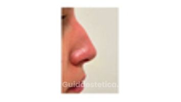 Dott. Giovanni Migliorini Rinofiller