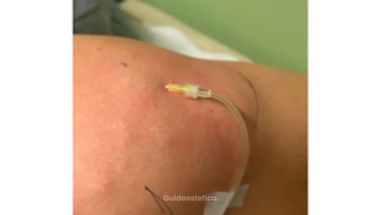 Dott. Giovanni Migliorini Carbossiterapia: benefici su microcircolazione e cellulite