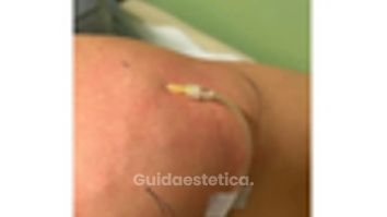 Dott. Giovanni Migliorini Carbossiterapia: benefici su microcircolazione e cellulite