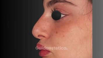 Dott. Fioravante Orefice Processo di guarigione dopo una Rinoplastica Parziale