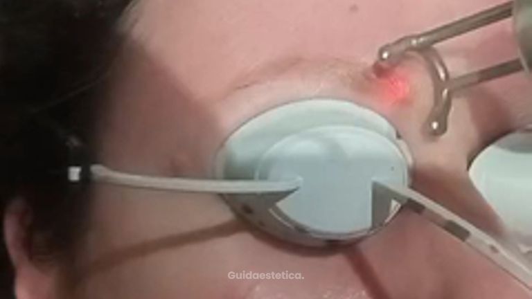 Dott.ssa Cornelia Florea Rimozione tatuaggio sopracciglio con laser