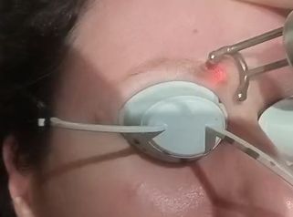 Dott.ssa Cornelia Florea Rimozione tatuaggio sopracciglio con laser