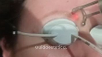 Dott.ssa Cornelia Florea Rimozione tatuaggio sopracciglio con laser