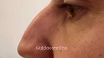 Venini Ventitre Medical Center Rinofiller uomo per correggere gobba e punta Dott. Benoit Menye