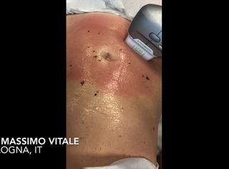 Dott. Vitale: Ultraformer addominale