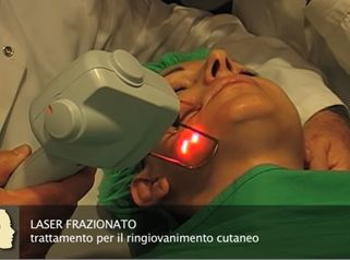 LASER ESTETICA: Trattamento per il ringiovanimento cutaneo con Laser Frazionato