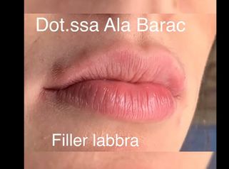 Filler labbra - Dott.ssa Ala Barac