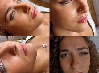 Venini Ventitre Medical Center Filler labbra: risultati naturali su diversi tipi di labbra