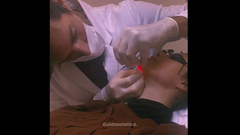 Endolift per il lifting non chirurgico