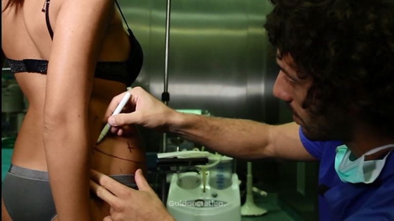 La liposuzione secondo il Dott. Giuseppe Manzo