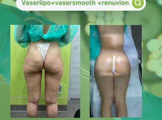 Dott. Umberto Tozzi Vaserlipo_vasersmooth_renuvion