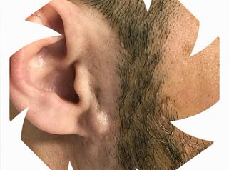 Prof. Dott. Massimiliano Giuliano Cisti sebacea all’orecchio