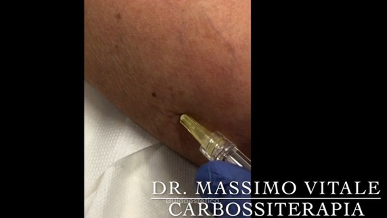 Dott. Vitale: Carbossiterapia