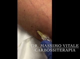 Dott. Vitale: Carbossiterapia