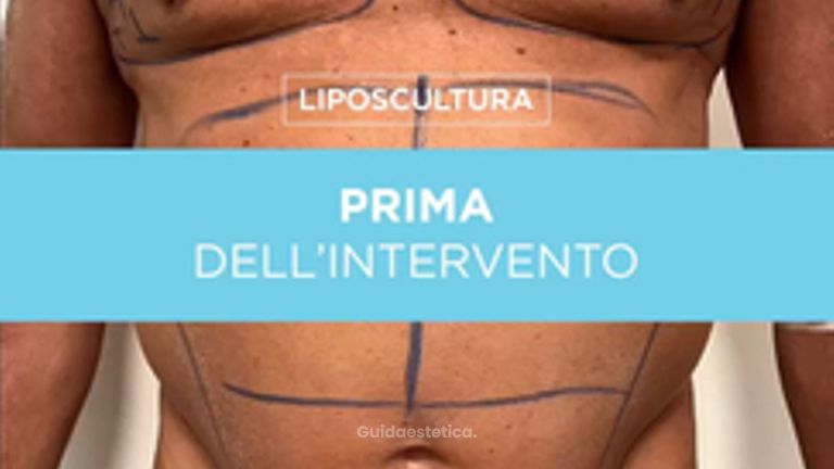 Liposcultura - Prof. Giuseppe A. Ferraro