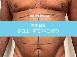 Liposcultura - Prof. Giuseppe A. Ferraro