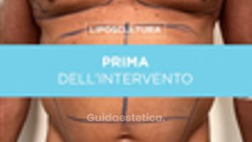 Liposcultura - Prof. Giuseppe A. Ferraro