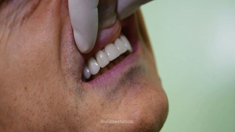 La faccette dentali - Dott. Fabio Vaja