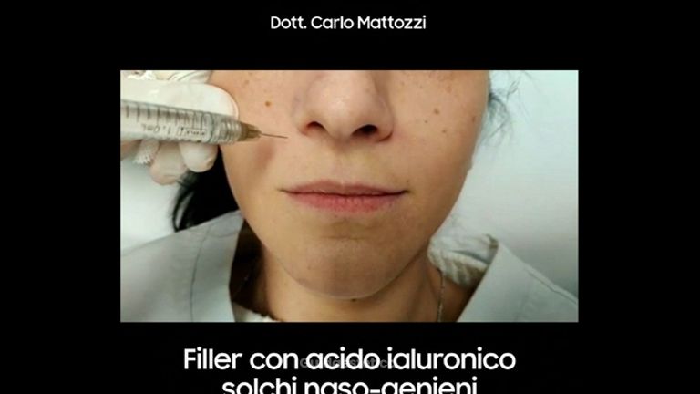 Filler acido ialuronico - Dott. Carlo Mattozzi