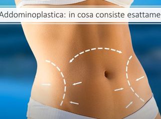 Addominoplastica, chirurgia estetica: cos´é e quando farla? || Dr Montemurro - Chirurgo Plastico