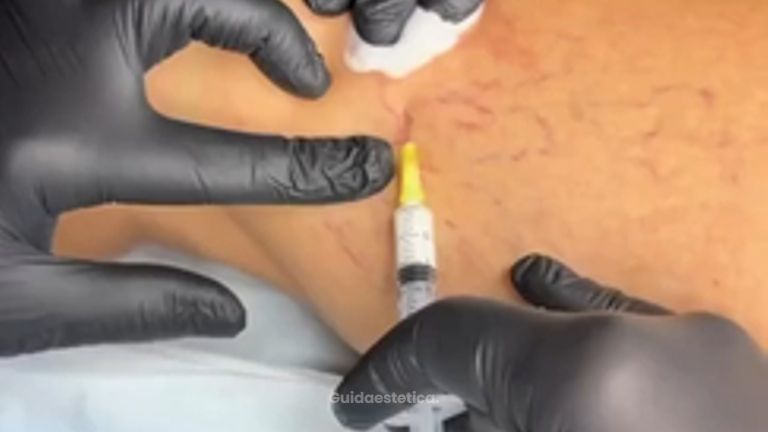 PPM Medical Scleroterapia: Il Trattamento per Capillari e Vene Varicose