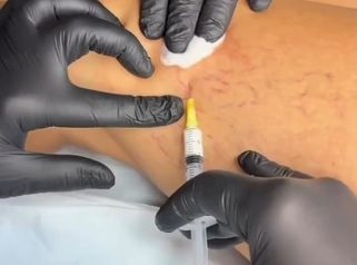 PPM Medical Scleroterapia: Il Trattamento per Capillari e Vene Varicose