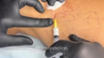 PPM Medical Scleroterapia: Il Trattamento per Capillari e Vene Varicose