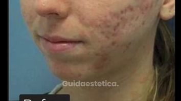 Acne - Dr Benoit Menye