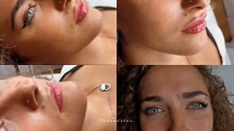 Dott. Benoit Menye Filler labbra: risultati naturali su diverse pazienti