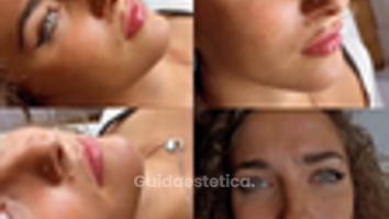 Dott. Benoit Menye Filler labbra: risultati naturali su diverse pazienti