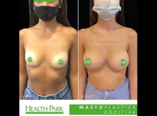 Mastoplastica additiva - Health Park- Andrea Grimaldi Medical Care
