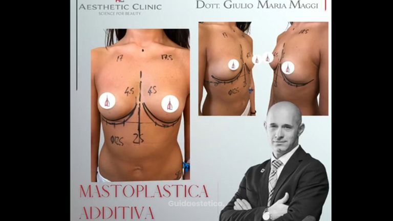 Mastoplastica additiva - Aesthetic Clinic del Dott. Giulio Maria Maggi