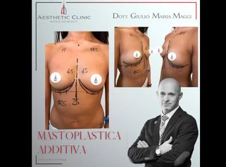 Mastoplastica additiva - Aesthetic Clinic del Dott. Giulio Maria Maggi