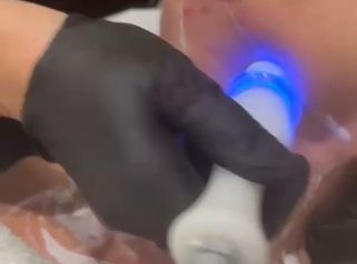 Dott.ssa Cornelia Florea Radiofrequenza collo con Exilis Ultra 360