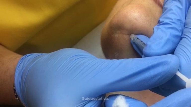 Trattamento righe verticali del collo con botulino