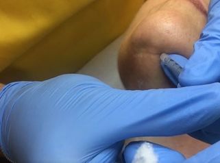 Trattamento righe verticali del collo con botulino