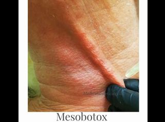 Mesobotox
