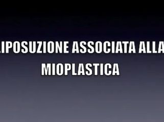 DR. MASSIMO RE - LIPOSUZIONE ASSOCIATA ALLA MIOPLASTICA (aumento dei polpacci con protesi)